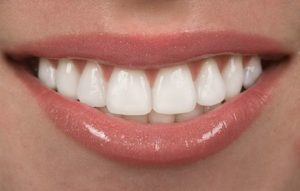 closeup of woman with dental veneers